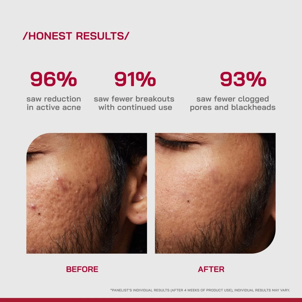 2% Salicylic Acid Anti-Acne Serum - Image 3