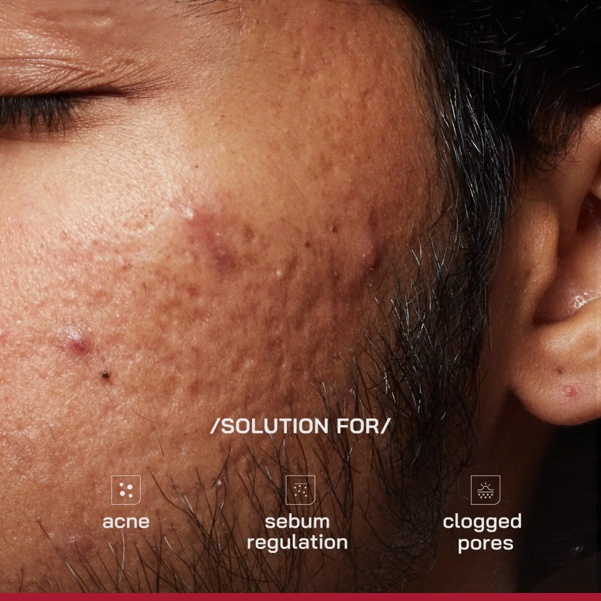 2% Salicylic Acid Anti-Acne Serum - Image 4