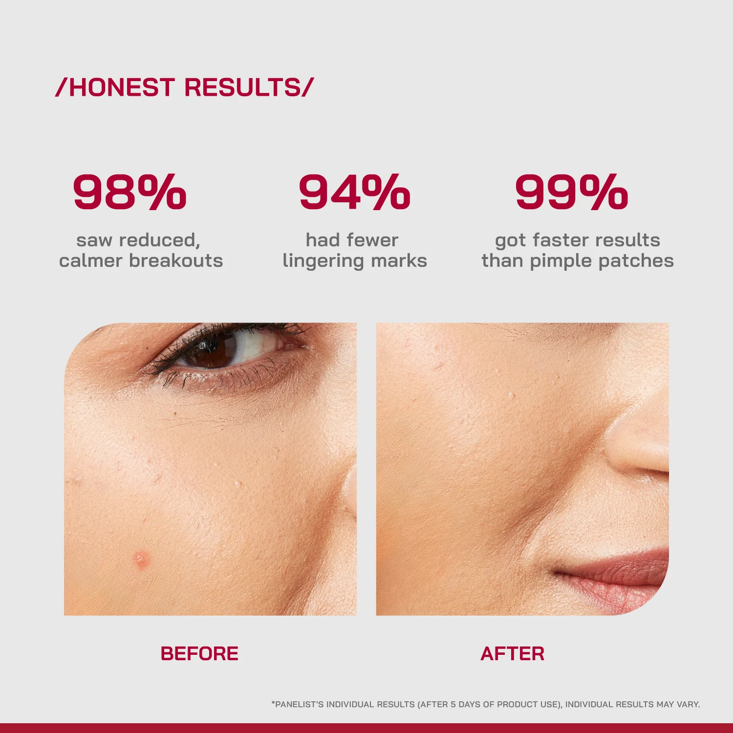 Salicylic Acid Acne Spot Treatment Gel - Image 4